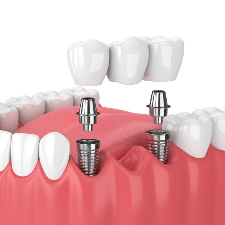 Best Dental Implantsin Amanora Park Town Hadapsar