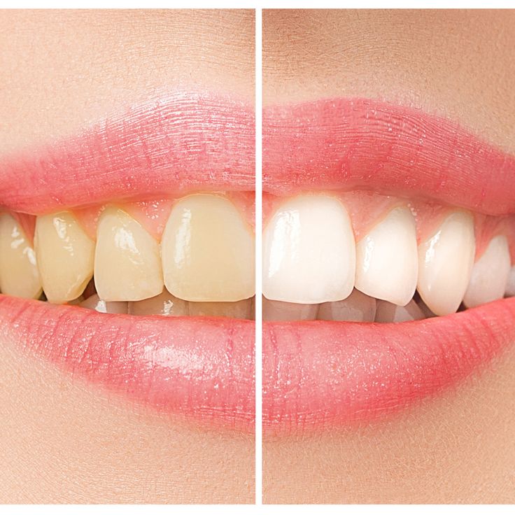 Best Teeth Whitening Treatment in Amanora Park Town Hadapsar
