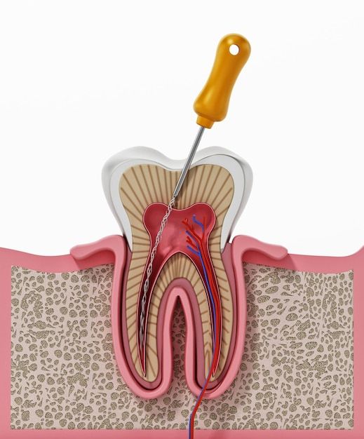 Best Root Canal Treatment in Amanora Park Town Hadapsar