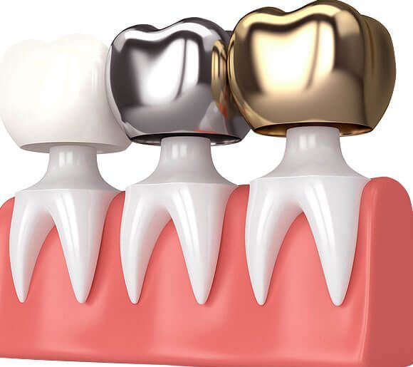 Dental Crowns and Tooth Bridges in Amanora Park Town Hadapsar